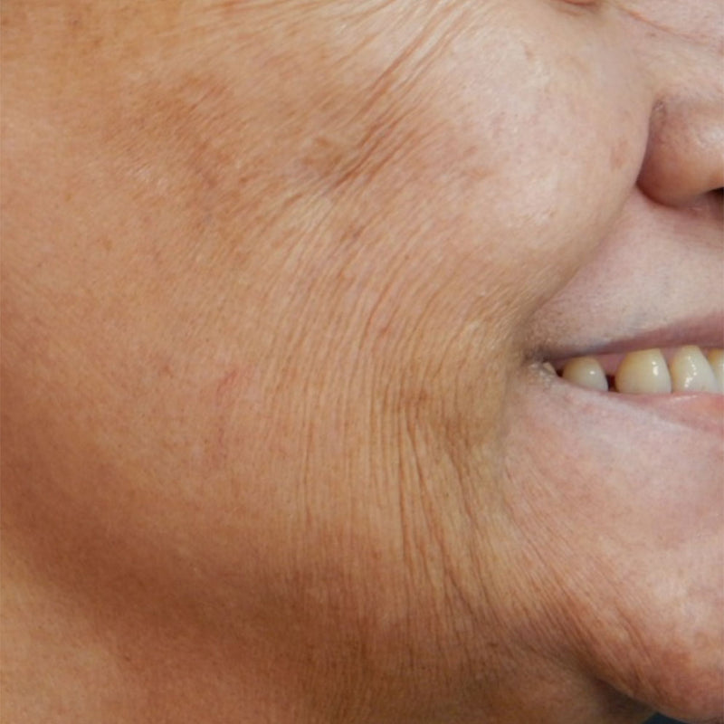 Bio Remodelling hyaluronic acid injections Adelaide Sculpsure