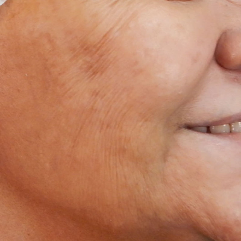 Bio Remodelling hyaluronic acid injections Adelaide Sculpsure